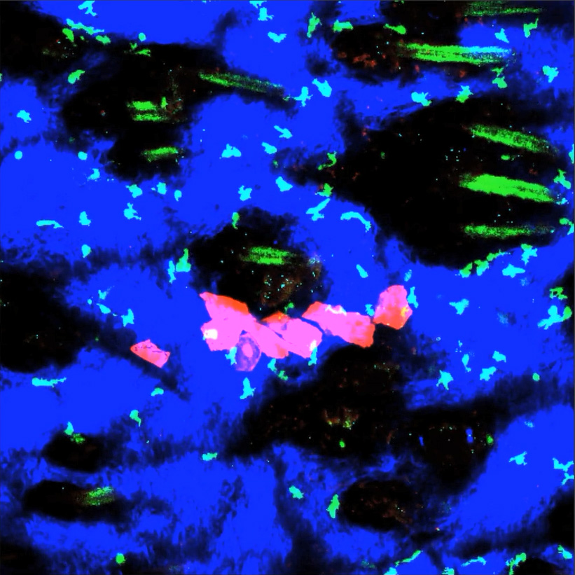 TRM cells surrounding and keeping the melanoma cells in check